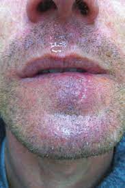 Squamous cell cancers can usually be removed completely (or treated in other ways), although they are more likely than basal cell cancers to grow into deeper layers of skin and spread to other parts of the body. Squamous Cell Carcinoma Of The Lower Lip Oral Health Group
