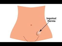 Image result for Inguinal hernia child