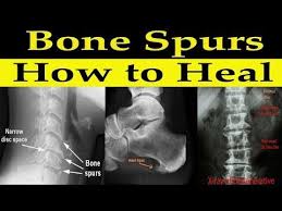 How To Heal Bone Spurs Naturally Dr Alan Mandell Dc Youtube Bone Spurs Heal Spurs Shoulder Bone Spur