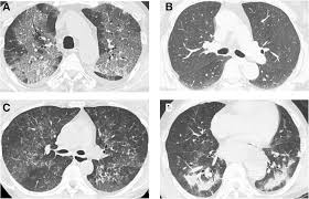 Have a look around on yelp and other popular reviews sites to see what. Prognostic Significance Of Crazy Paving Ground Grass Opacities In Non Hiv Pneumocystis Jirovecii Pneumonia An Observational Cohort Study Bmc Pulmonary Medicine Full Text