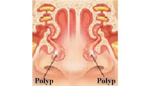 Many of us never proclaim that we will expect to cure nasal polyps; Abnormal Growth Of Nasal Tissue Which Causes Breathing Problem Is Called Nasal Polyp Surgery Of Nasal Polyps Is Possi Polyp Breathing Problems Polyps Symptoms