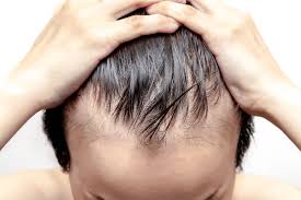 Temporary hair loss can be a sign of a medical issue, like anemia or thyroid problems. 6 Signs Of Male Pattern Baldness Jonsson Protein