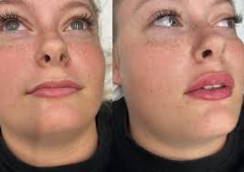 We love Virgin lips🤩 Another One of Our Amazing Client who is Starting her  Lip Filler Journey.😊 How Beautiful & Natural do these Lips look👄1ml. If  you Want to Start your Lip