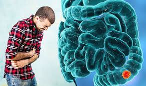 It begins in the last part of the digestive tract, which is the large intestine (colon). Bowel Cancer Rates Of The Disease Are Rising Watch Out For These Symptoms Express Co Uk