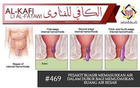 Keluarnya darah dari hidung juga disebut dengan mimisan dan kondisi ini akan begitu menakutkan bagi yang belum pernah mengalami. Pejabat Mufti Wilayah Persekutuan Al Kafi 469 Pesakit Buasir Memasukkan Air Dalam Dubur Bagi Memudahkan Buang Air Besar