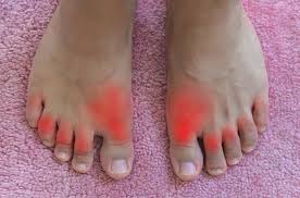 Gout memerlukan rawatan berterusan yang lama. Penyakit Gout Turut Berisiko Dihidapi Oleh Golongan Kanak Kanak