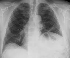 Pneumologie Unsere Krankheitsbilder Im Rontgenbild