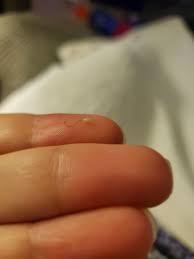 Sometimes, dead skin can clog a hairfollicle. White Seed On End Of Ingrown Hair Popping