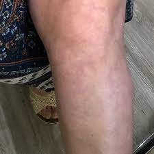 Thrombose Am Knie Meniskus