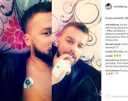 View the profiles of professionals named piróg on linkedin. Michal Pirog O Operacji W Klinice Mml Opinia I Relacja Z Zabiegu