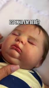 Acné neonatal en bebés: ¿Normal o preocupante?