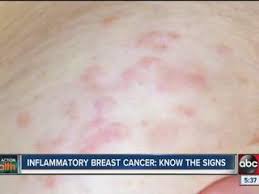 • breast that feels warm to touch and may look infected. Breast Cancer