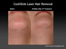 Savvy laser hair removal of san antonio helps you say goodbye to unwanted, dark hair. Cutera Laser The Dermatology Clinic