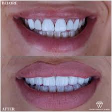 How much does a dental crown cost? Smile Makeover Turkey Veneers Teeth Dental Veneers Dental Implants Cost Cosmetic Dentistry