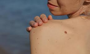 Address 68 avondale avenue, east lismore, nsw 2480, australia, website, phone number +61 2 6622 8155, opening hours, jobs, reviews, map Skin Cancer How To Keep Track Of Your Moles And Spot Danger Signs Hello