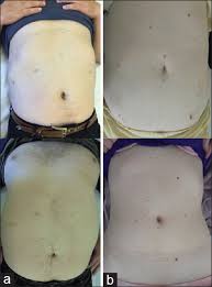 Check spelling or type a new query. Laparoscopic Liver Resection In Caroli Disease A Single Centre Case Series Abstract Europe Pmc