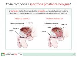 Lista alimenti morbo crohn prostatite cronica la. Prostata Ingrossata Sintomi Cause Cura Rischi Dieta E Rimedi Naturali