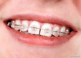 Aparelho Ortodontico Em Criancas Precisa Extrair Dentes De Leite