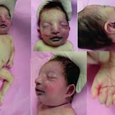 PDF) A very rare case of a newborn with tetrasomy 9p and literature review