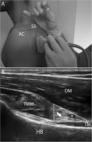 Image result for Axillary Nerve Block