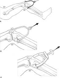 Hcp contentposted june 18, 2014 in zimmer biomet surgical products. Traction Musculoskeletal Key