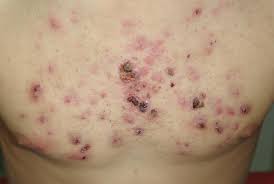 Ne laissez plus les points noirs ou comédons nuire à votre beauté, redonnez vie à votre peau en libérant vos pores de tous types d'impuretés avec l'aspirateur multifonctions clean'skin ! Dermato Info L Acne