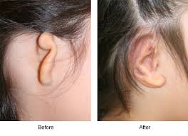 Microtia Surgery Can Help Restore Normalcy In The Life Of A Child Affected By This Condition It Offers The Child A Plastic Surgery Cosmetic Surgery Combo Skin