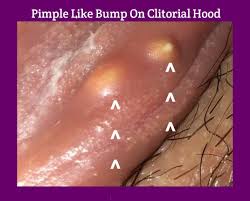 Rashes bumps and lumps below the belt. Causes And Remedies Of Pimple Like Bump On Clitoral Hood Public Health
