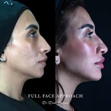 subtle volume and seamless definition using RHA3 dynamic filler 🤍  @teoxaneegypt