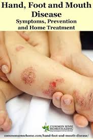Hand Foot And Mouth Disease Spot It Avoid It Treat It Hand Foot And Mouth Hand And Mouth Disease Hand Diseases