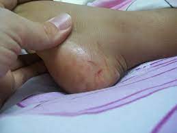 When a venomous snake bites another snake, the victim dies (be it a venomous or a if you're certain the snake that delivered the bite was venomous, you need to know whether the snake was an. Snakebite Wikipedia