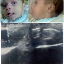 The Patient With Prader Labhardt Willi Syndrome He Mental Retardation Download Scientific Diagram