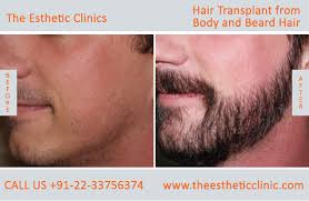 Our center is formed to create awareness about the availability of the most advanced cosmetic surgery procedures and is tended. Best Hair Transplant In Mumbai Body Beard Hair Transplant To Head India The Esthetic Clinics