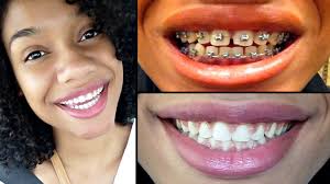 How long does it take to get braces off? Pin On Kimberlyn Xo