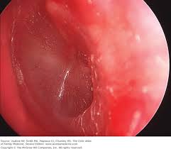 Image result for Acute Otitis Externa