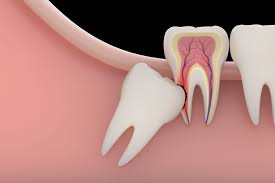 However, the overall cost of your wisdom teeth surgery depends on these three factors: Wisdom Teeth Removal Santa Fe Nm Taos Nm Los Alamos Nm Espanola Nm Las Vegas Nm Oral Surgery And Dental Implant Center Of Santa Fe