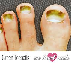 This can happen if you're hanging around places with a high prevalence of fungi, like swimming pools, changing rooms or saunas. Ugly Green Toenails Causes Prevention Treatment