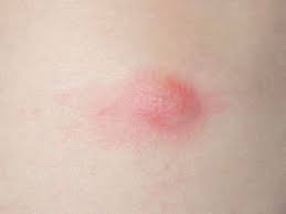 Image result for Urticaria pigmentosa children