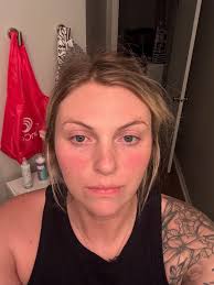 Lyme disease diagnosis and treatment for autoimmune disease patients