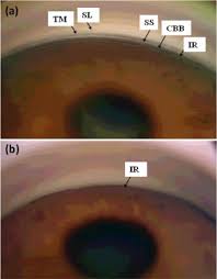Image result for Gonioscopy