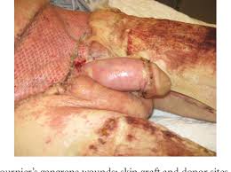 Patients were managed by our institutional practice of complete primary wound closure. Figure 6 From Fournier S Gangrene In A Heterosexual Man A Complication Of Neisseria Meningitidis Urethritis Semantic Scholar