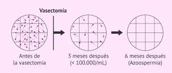 Que Es La Vasectomia Y Como Se Hace Posibilidad De Embarazo