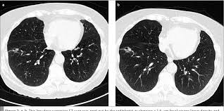 Computed tomography scan (ct or cat scan). Figure 2 From Screening For Lung Cancer With Low Dose Ct Scans Semantic Scholar