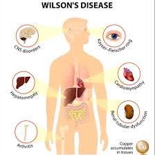 Image result for Wilson Test