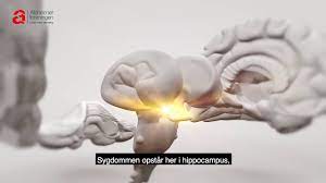 Parkinsons sygdom, mener man, skyldes en kombination af gener og påvirkning fra giftstoffer som pesticider og tungmetaller. Hvad Er Demens Alzheimerforeningen Alzheimer