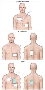 Image result for Ventricular Fibrillation Management in the Adult