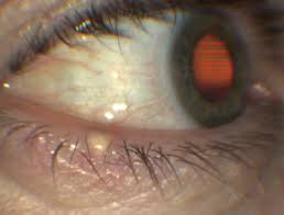 Image result for milium cyst on eyelid