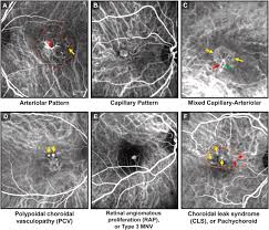 The duchess' mother is black, and her father is white. Incomplete Response To Anti Vegf Therapy In Neovascular Amd Exploring Disease Mechanisms And Therapeutic Opportunities Sciencedirect