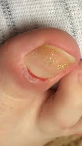 Image result for Akutní zánět nehtového lůžka