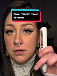Plasma Pen Mole Removal at Home